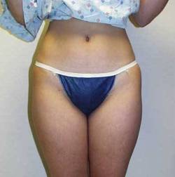 Before Image: Patient # 89230 - 
