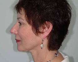 Before Image: Patient # 29216 - 