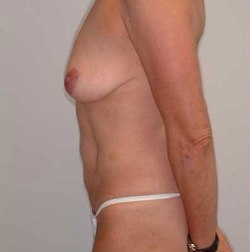 Before Image: Patient # 11966 - 