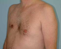 Before Image: Patient # 78514 - 