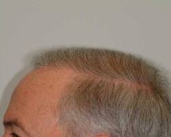 After Image: Patient # 41082 - 