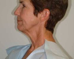 Before Image: Patient # 92609 - 