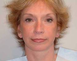 After Image: Patient # 24341 - 