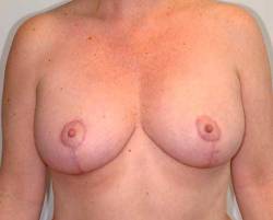 After Image: Patient # 58331 - 
