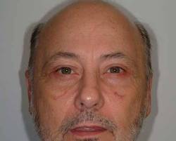After Image: Patient # 93739 - 