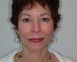 Before Image: Patient # 29216 - 