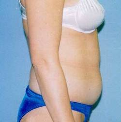 Before Image: Patient # 26228 - 