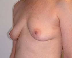 Before Image: Patient # 79152 - 
