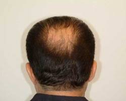 Before Image: Patient # 84213 - 