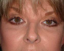 After Image: Patient # 89880 - 
