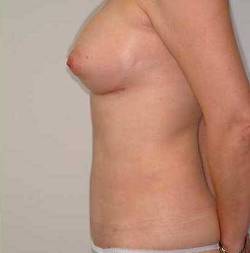 After Image: Patient # 28345 - 