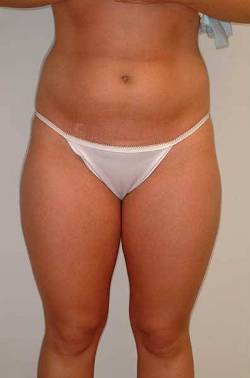 before image of patient who received liposuction by Dr. Barrera in Houston, TX