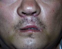 Before Image: Patient # 50751 - 