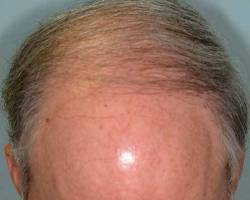 Before Image: Patient # 41082 - 