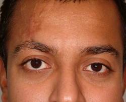 After Image: Patient # 54163 - 