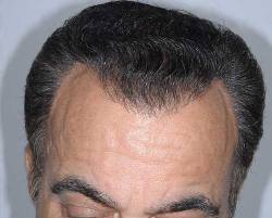 After Image: Patient # 84213 - 