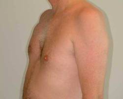 After Image: Patient # 78514 - 