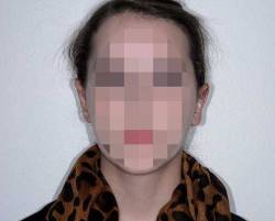  young woman after otoplasty ear surgery with ears closer to head