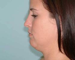Before Image: Patient # 80256 - 
