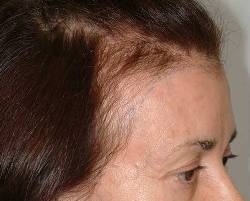 Before Image: Patient # 90484 - 