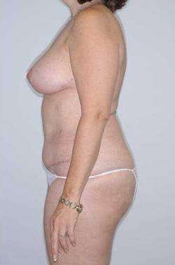 After Image: Patient # 35352 - 