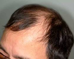 Before Image: Patient # 94035 - 
