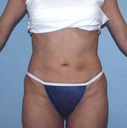 After Image: Patient # 55841 - 