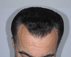 After Image: Patient # 84213 - 