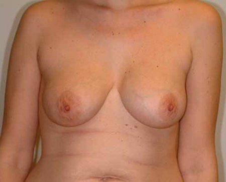 After Image: Patient # 34852 - 