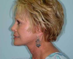 After Image: Patient # 21982 - 