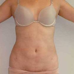 After Image: Patient # 79803 - 