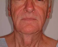 Before Image: Patient # 11305 - 