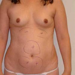 Before Image: Patient # 79803 - 