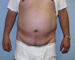 Before Image: Patient # 84231 - 