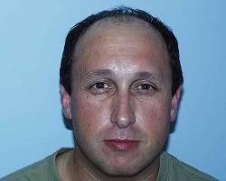 Before Image: Patient # 12498 - 