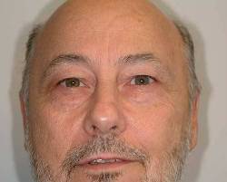 Before Image: Patient # 93739 - 
