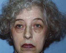 Before Image: Patient # 86576 - 