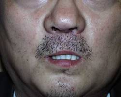 After Image: Patient # 50751 - 