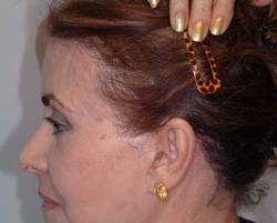 After Image: Patient # 33969 - 