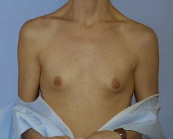 Before Image: Patient # 44398 - 