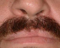 After Image: Patient # 69317 - 