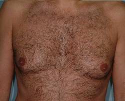 Before Image: Patient # 61222 - 