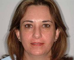 Before Image: Patient # 23251 - 