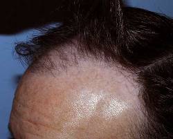 Before Image: Patient # 20729 - 