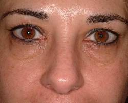 Before Image: Patient # 23251 - 