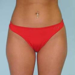 Before Image: Patient # 39008 - 