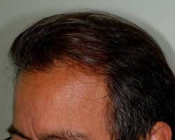 After Image: Patient # 94035 - 
