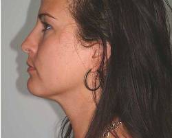 After Image: Patient # 80256 - 