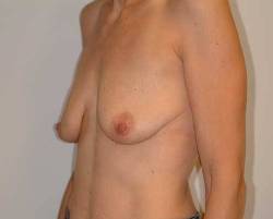 Before Image: Patient # 78770 - 