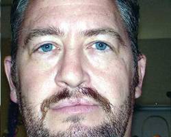 Before Image: Patient # 69317 - 